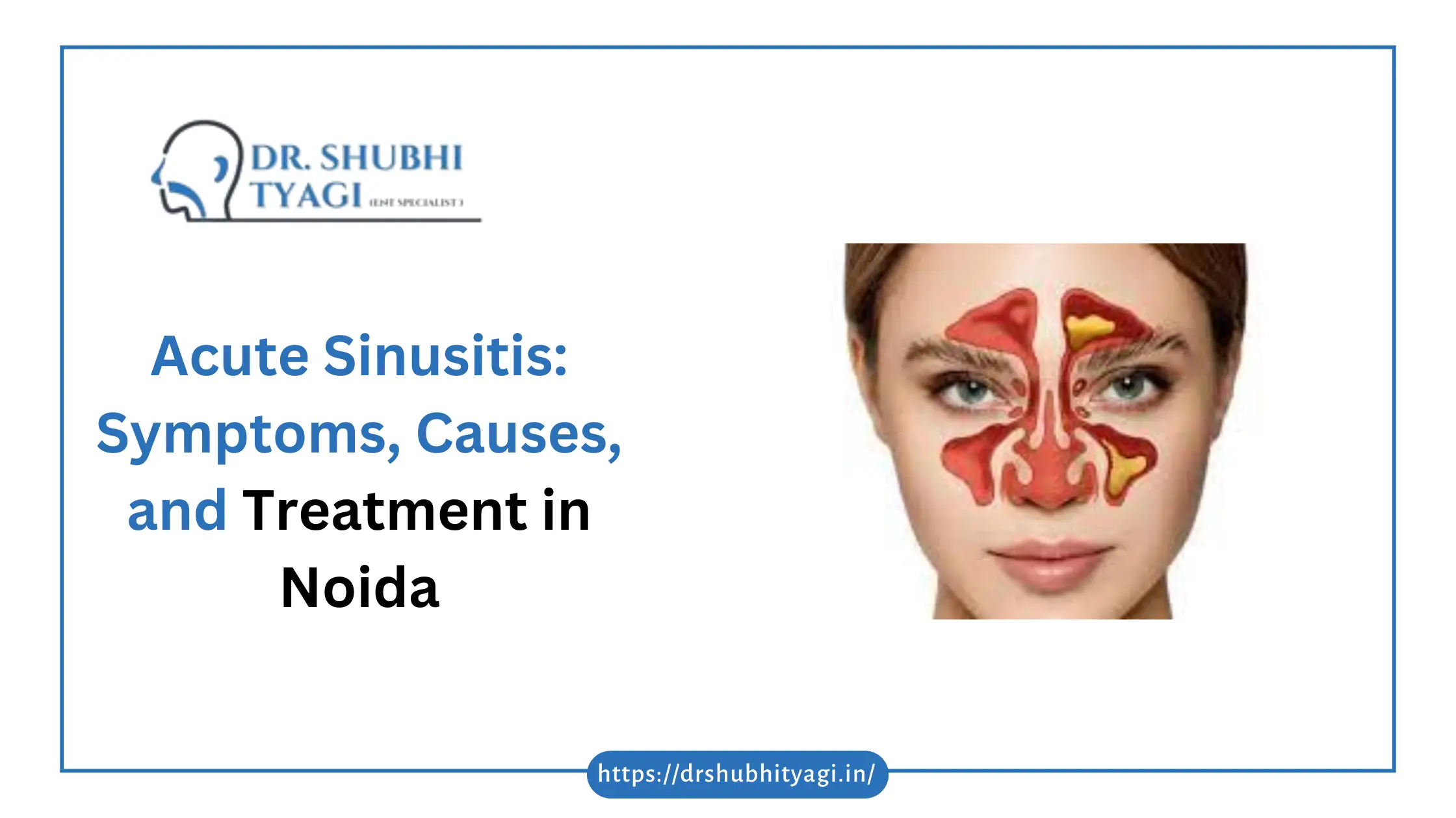 Acute Sinusitis in noida