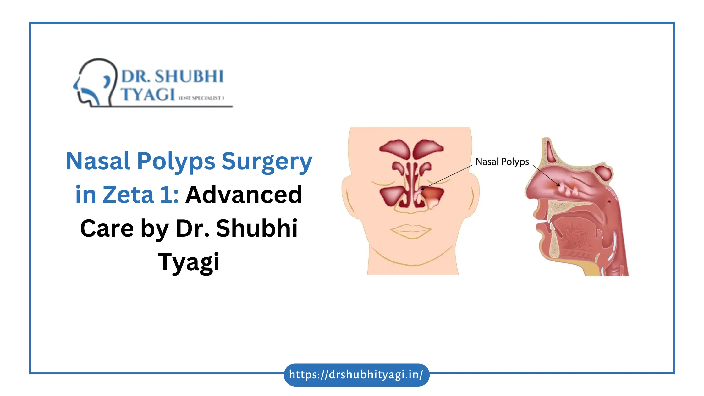 Nasal Polyps Surgery in Zeta 1