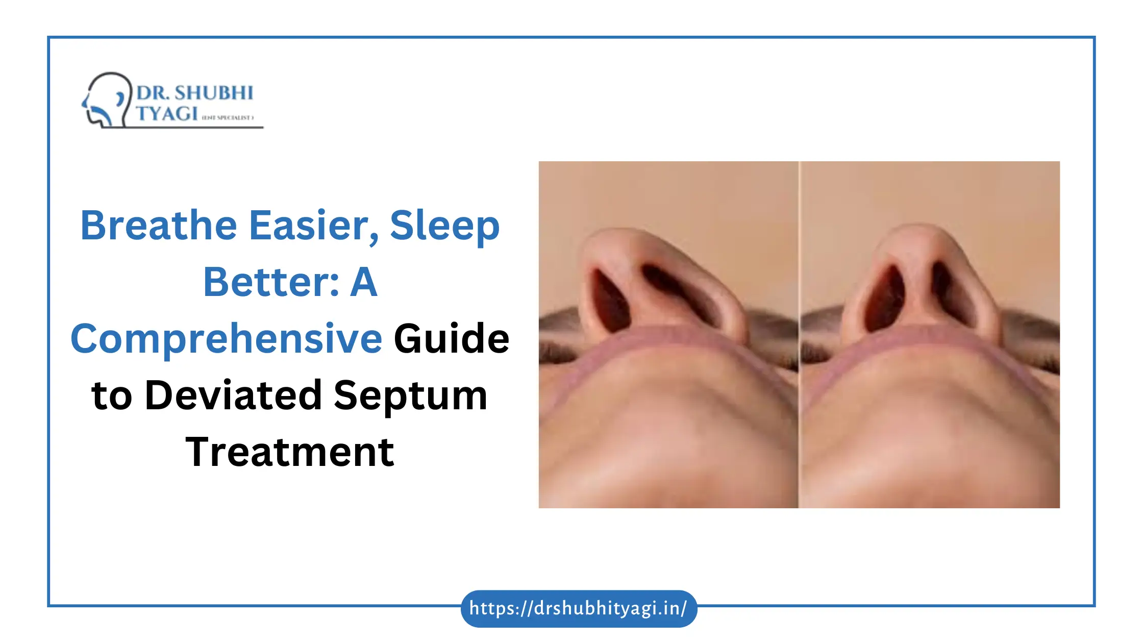 Deviated Septum treatment in Alpha 3