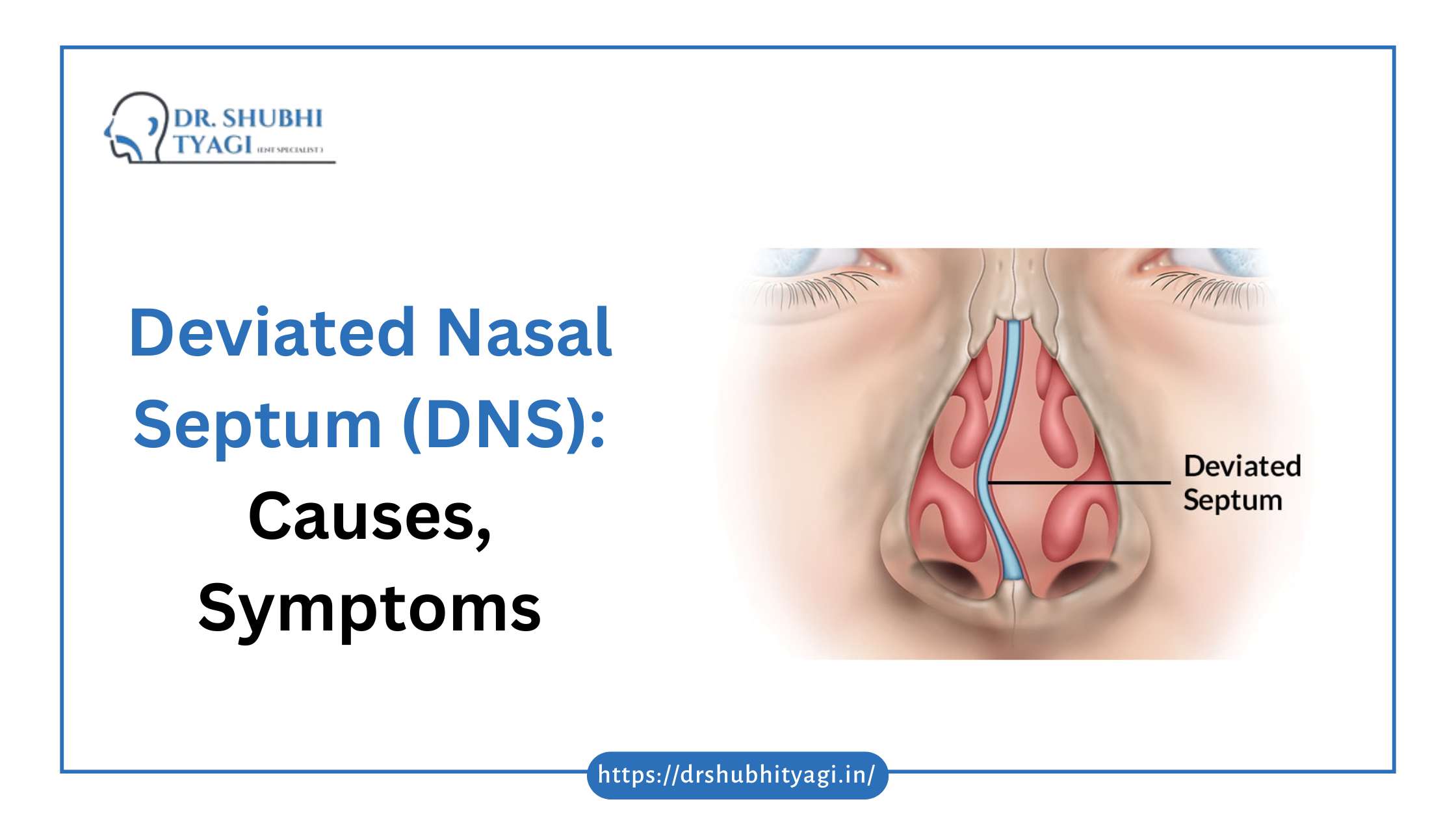 Deviated Nasal Septum (DNS): Causes, Symptoms, and Expert DNS Surgery for a Breath of Fresh Air in Noida
