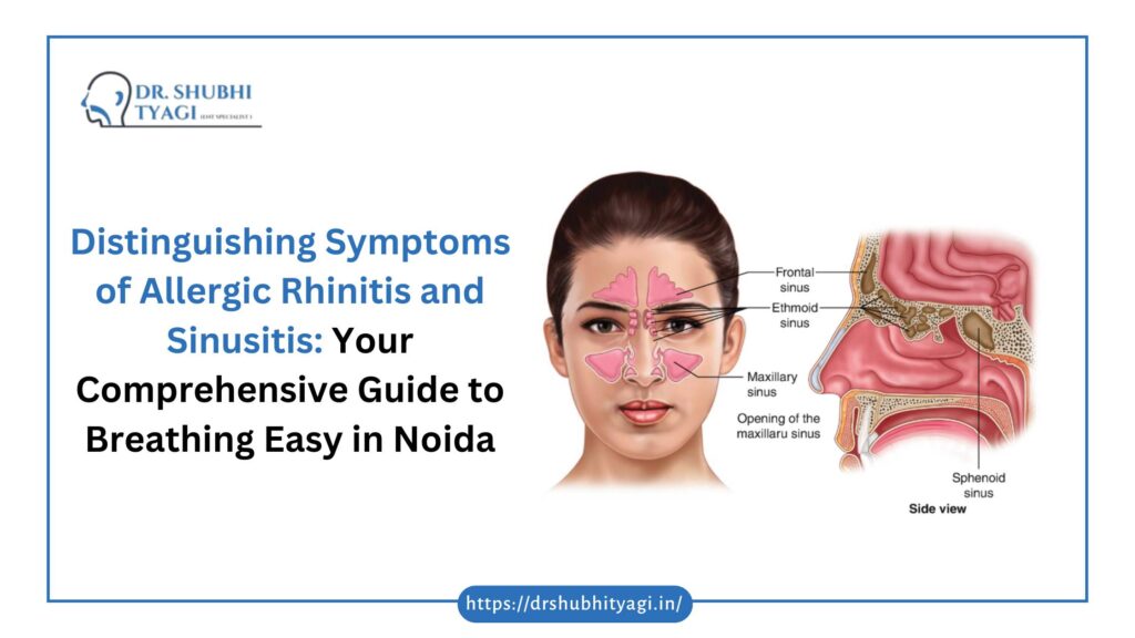 Rhinitis vs Sinusitis