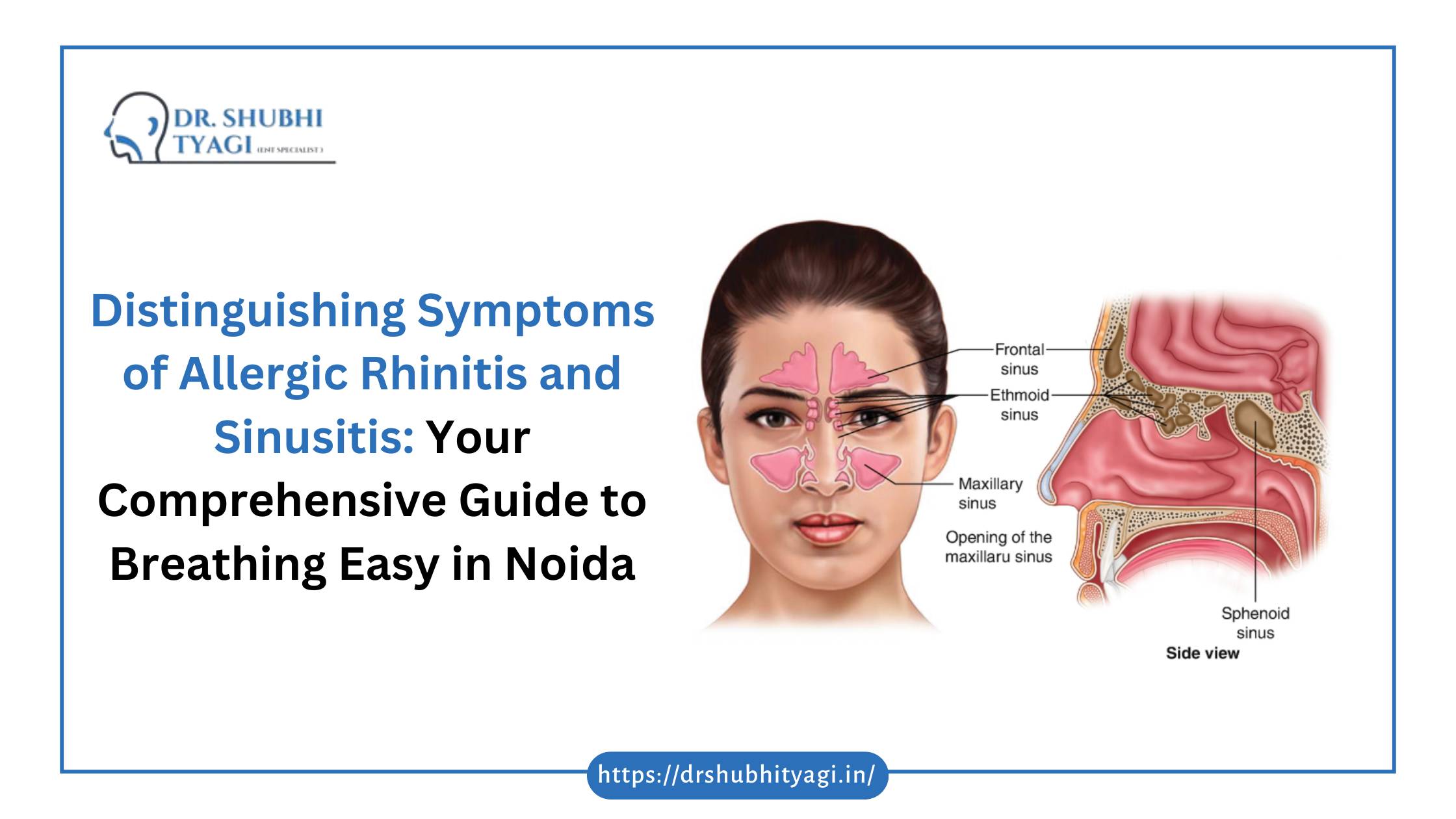 Rhinitis vs Sinusitis