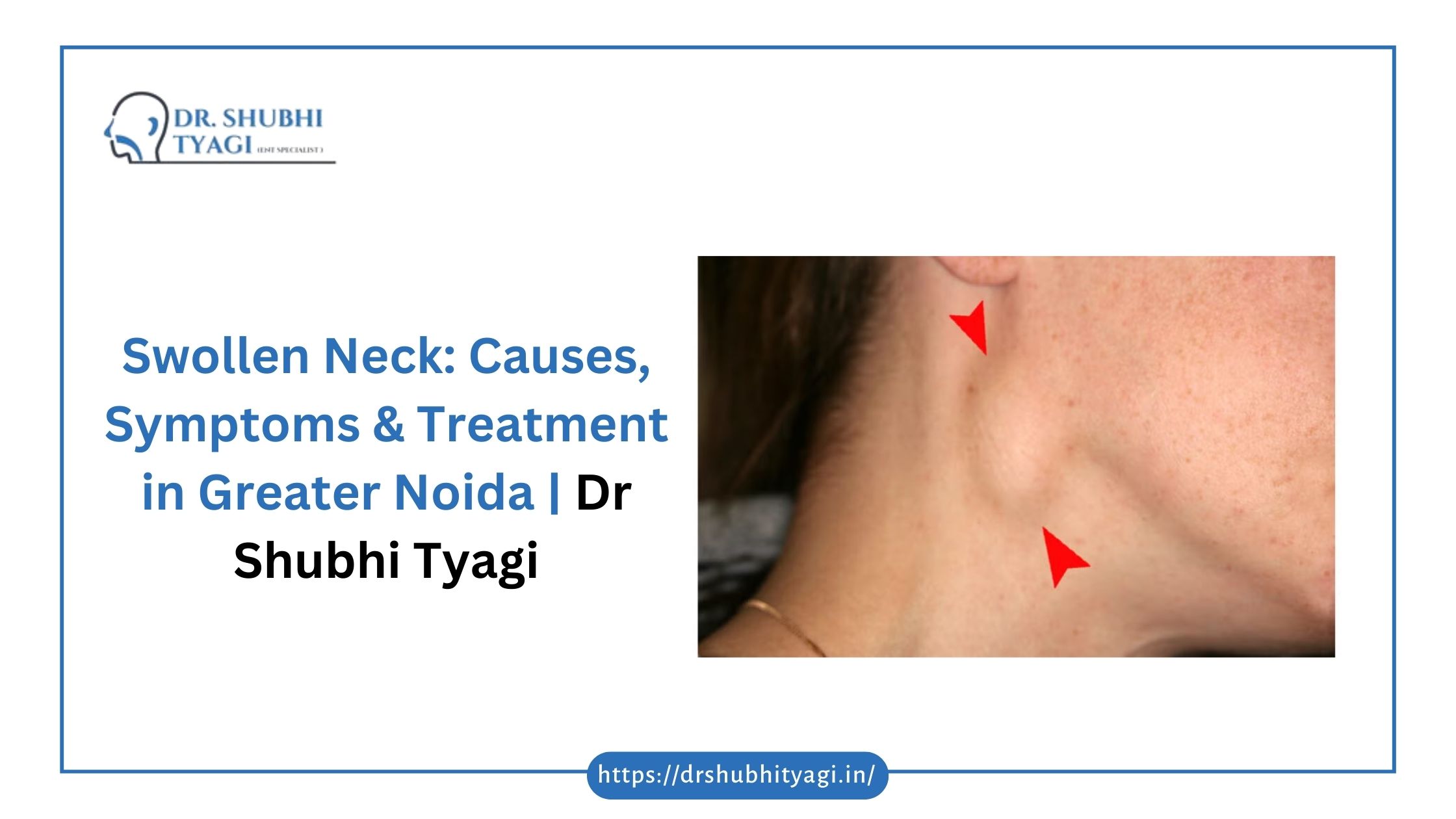 Swollen Neck Causes, Symptoms & Treatment in Greater Noida Dr Shubhi Tyagi Swollen Neck Causes & Treatment in Greater Noida