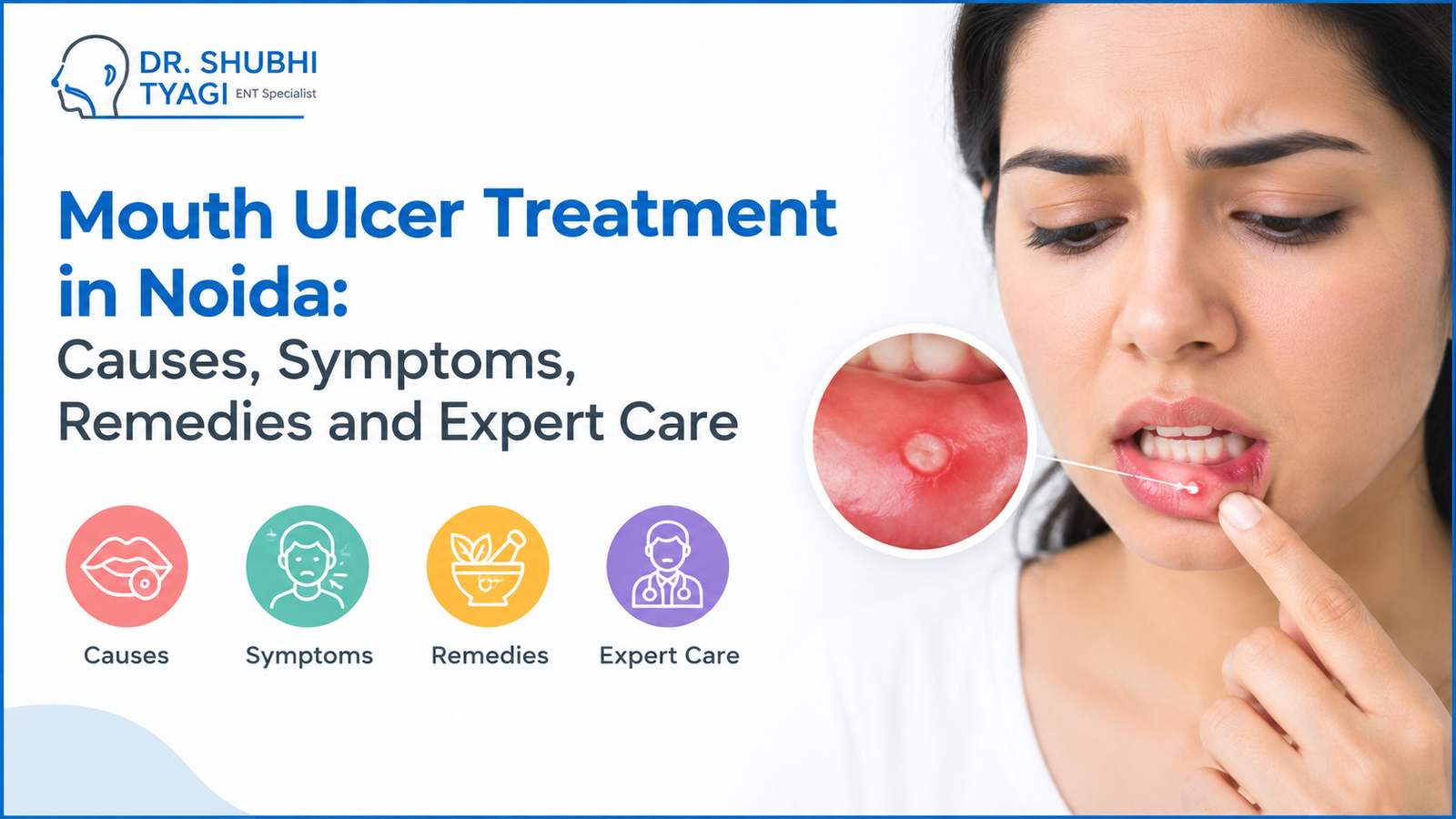 mouth ulcer treatment in Noida